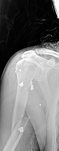 Name:  Humerus injury 5.56 (2).jpg
Views: 486
Size:  18.2 KB